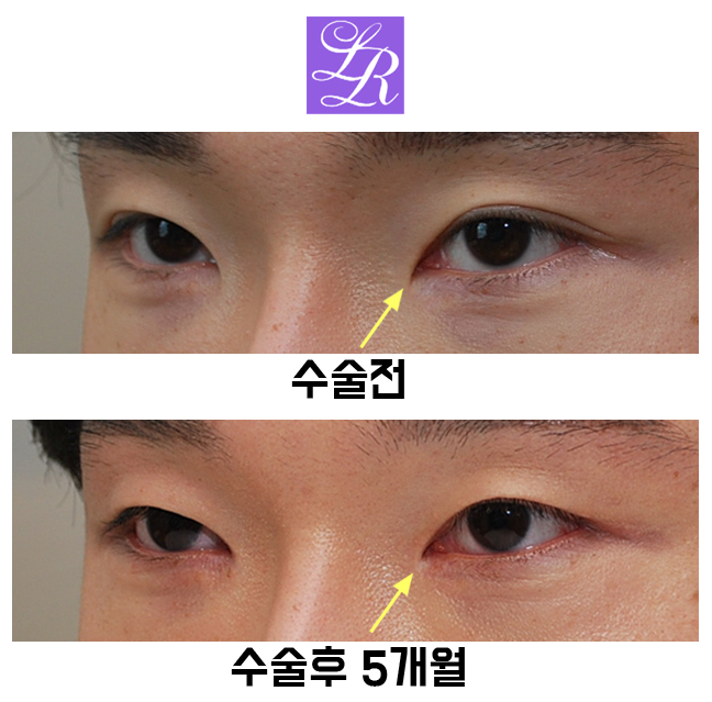 Review of Double Eyelid Removal Surgery + Epicanthic Fold Hook Removal Inner Corner Surgery image 4
