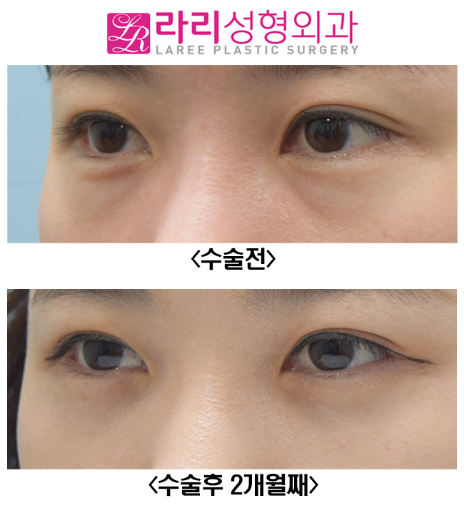 [라리성형외과] 다크서클, 필러? 지방이식? 말고 눈밑지방재배치수술 관련 이미지 2