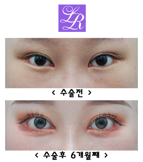 How Can You Correct Eyes With a Fierce Impression and Upturned Outer Corners? image 1