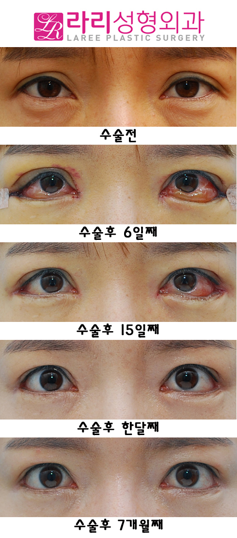 Sausage Correction, Epicanthoplasty, and Revision Surgery for Lateral Canthoplasty with Lowered Outer Eye Corners image 1