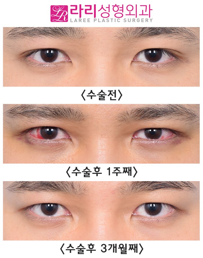 [라리성형외과] 자연쌍꺼풀없애기 수술 전후 사진 회복 기간 짝눈 교정 관련 이미지 2