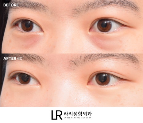[라리성형외과] 하루(1DAY) 투자로 예뻐지는 라리성형외과의 퀵 눈밑지방재배치수술 관련 이미지 4