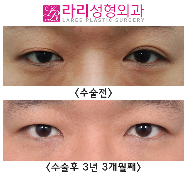 [Rari Plastic Surgery] Scar After Incisional Double Eyelid Surgery, Reversal Side Effects, and Correction of Uneven Eyelids with Double Eyelid Removal Surgery image 2