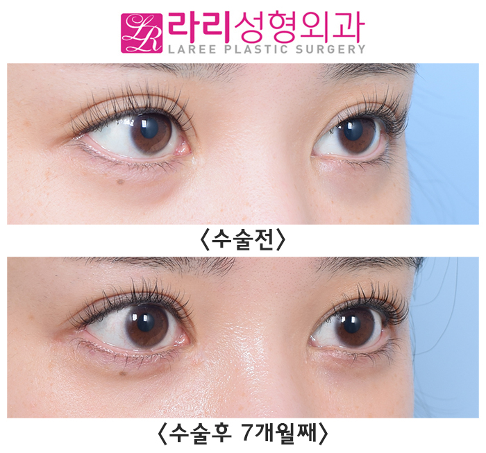 [라리성형외과] 한 번에 한 여러 가지 눈 수술 경과 (쌍꺼풀재수술, 앞트임복원, 뒤트임수술, 눈밑지방이식) 관련 이미지 2