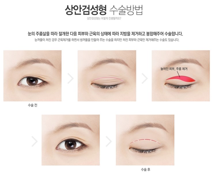 Upper Blepharoplasty and Lower Blepharoplasty image 3