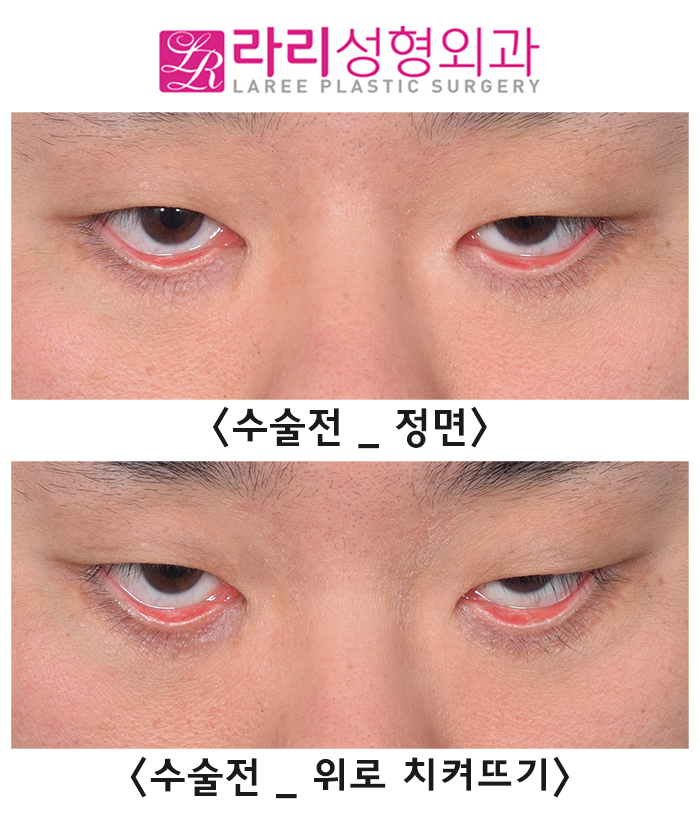 [Rari Plastic Surgery] The Most Common Complication of Lower Blepharoplasty: Lower Eyelid Ectropion image 3