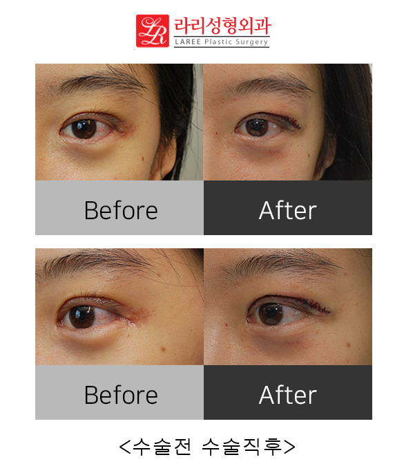 Correcting Double Eyelid Surgery Side Effects: Ectropion (feat. Rari Plastic Surgery) image 1