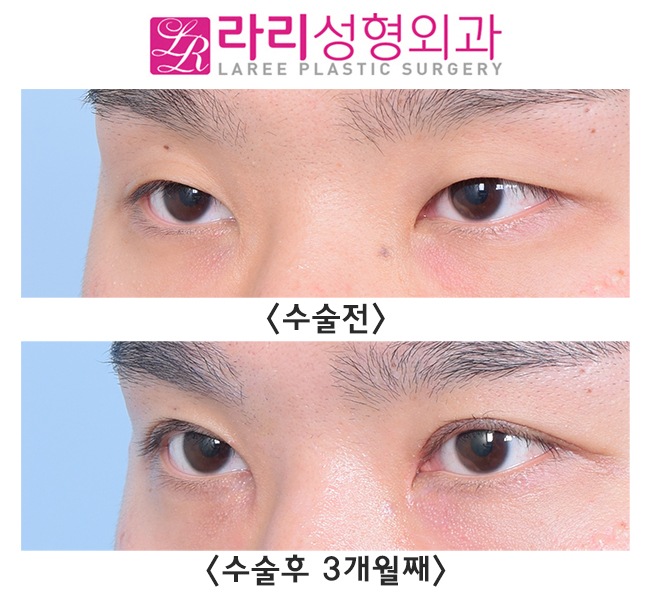 [라리성형외과] 이 정도 속쌍라인 절개눈매교정 어떤가요? 관련 이미지 2