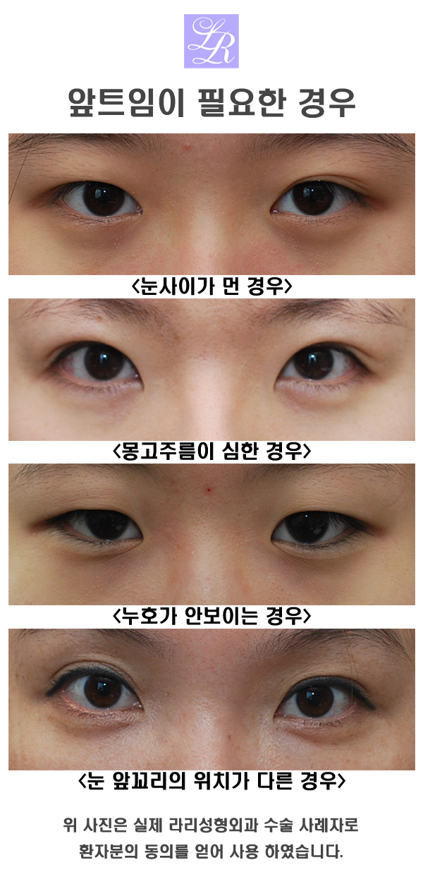 몽고주름없애는 앞트임후기 관련 이미지 2