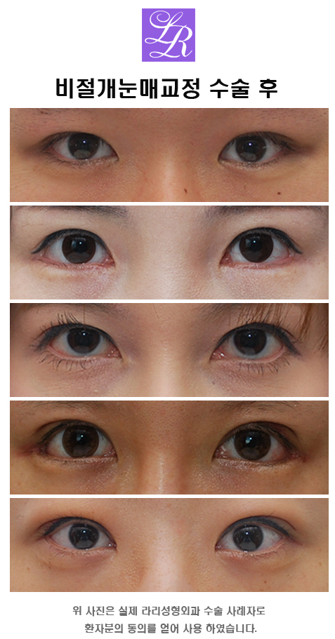 Non-Incisional Eye Correction Swelling, a Review Showing Its Effect image 4