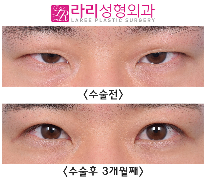 [라리성형외과] 이마미간 보톡스 그리고 절개 눈매교정 수술 전후 사진 단기 경과 관련 이미지 3
