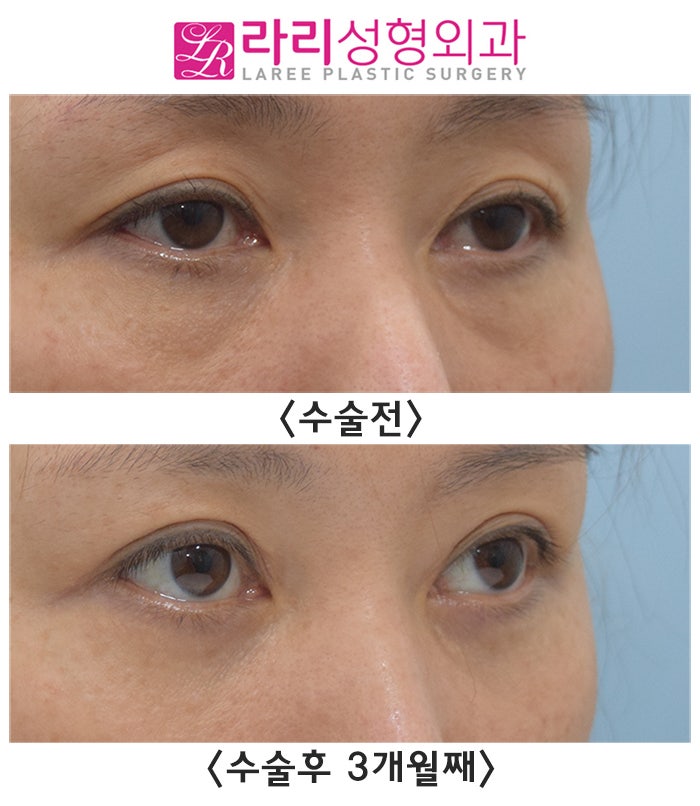 [라리성형외과] 절개눈매교정으로 윗눈꺼풀패임 개선될까?! (+ 눈밑지방재배치수술 ) 관련 이미지 3