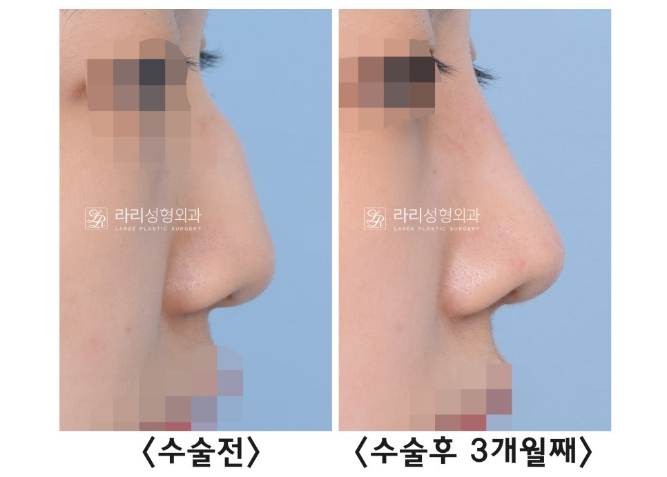 [라리성형외과] 절골을 포함한 매부리코 교정 수술(비순각 교정) 관련 이미지 1