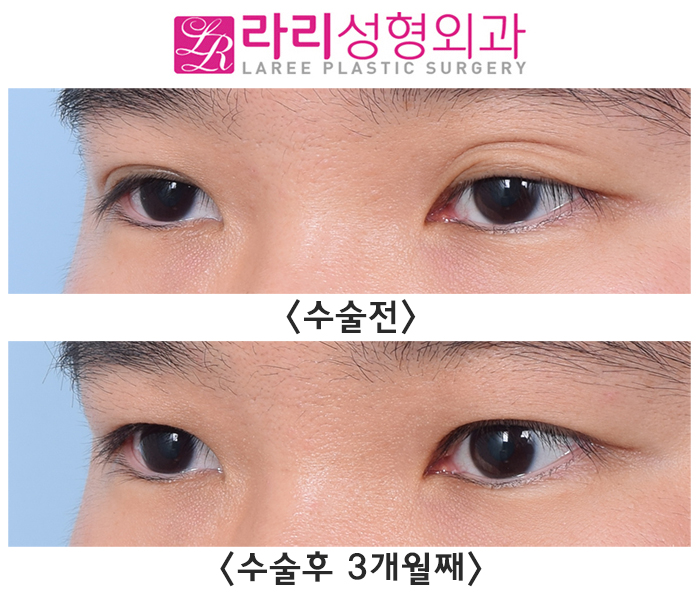 [라리성형외과] 쌍꺼풀 있어도 흐리멍텅한 눈 vs 쌍꺼풀 없어도 똘망똘망한 눈 관련 이미지 1
