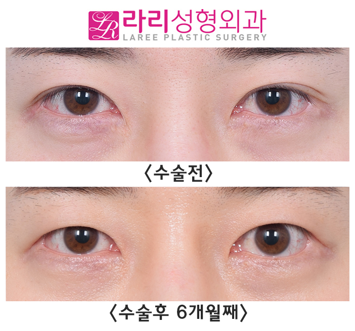 [라리성형외과] 매몰 쌍수 흉터 없애는데 쌍꺼풀없애는수술이 좋을지도?! 관련 이미지 2