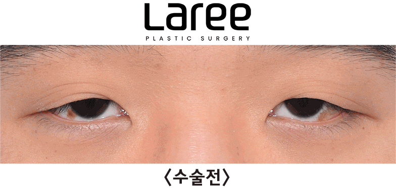 [Lari Plastic Surgery] Eyelid Correction Surgery and Upper Canthoplasty: Experiencing the Maximum Effect of Non-Double-Eyelid Eyelid Correction Without Medial Drooping image 11