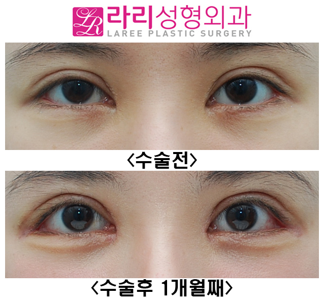 [라리성형외과] 눈매교정재수술 짝눈교정 뒤트임재수술 눈꼬리내리기 관련 이미지 1