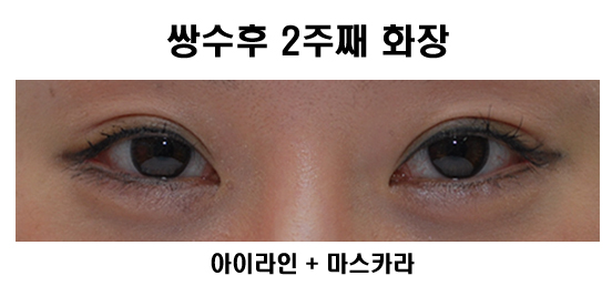 쌍수 실밥제거, 세수, 화장 시기 관련 이미지 4