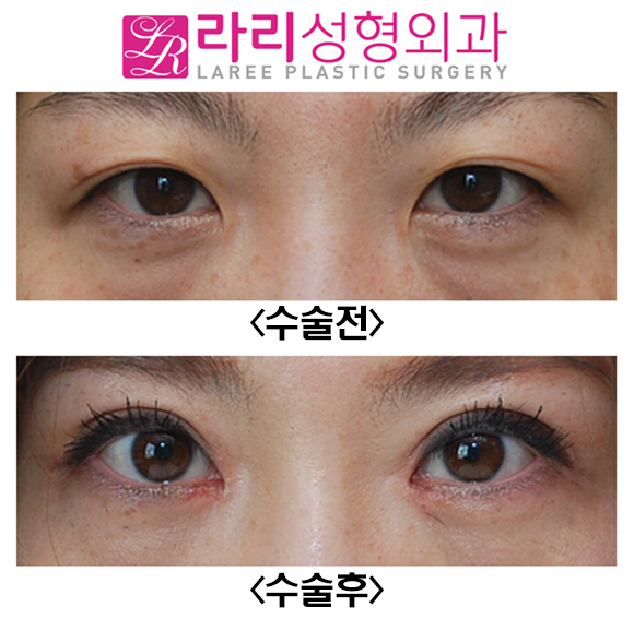 [Lari Plastic Surgery] Full Non-Incision Eye Correction, Effects and Before-and-After Photos (Different from Double Eyelid Surgery) image 1