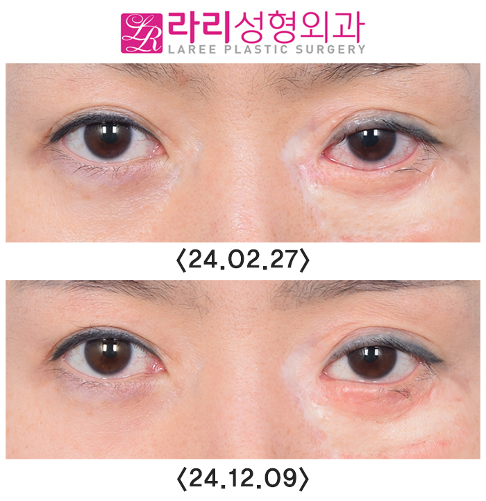 [라리성형외과] 연골이식으로 하안검외반의 일종인 삼백안 교정하기 관련 이미지 8