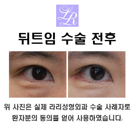 Lateral Canthoplasty Surgery - Recovery, Before and After, Good Results for the Eyes @Lari Plastic Surgery image 1