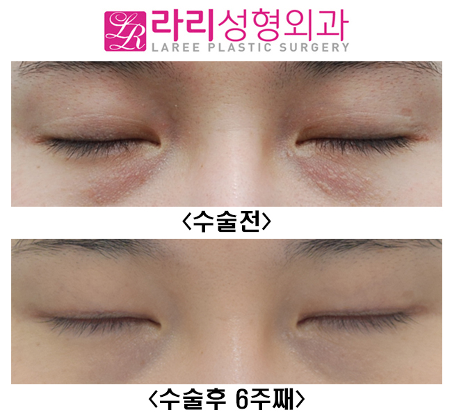 [Lari Plastic Surgery] Short-term progress after surgery to remove a natural double eyelid and make it monolid image 2