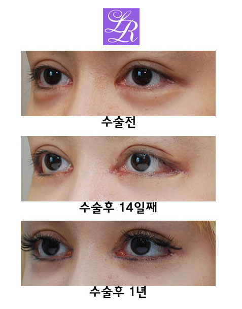 Simultaneous Medial and Lateral Canthoplasty Revision image 4