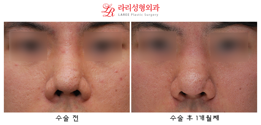 Correction of Upturned Nose and Contracted Nose, Revision Rhinoplasty Using Autologous Tissue (feat. Ear Cartilage) image 1