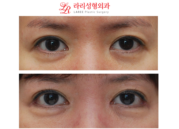 앞트임재수술,눈꼬리가 많이 올라가지 않은 경우의 눈꼬리내리기뒤트임재수술 관련 이미지 1