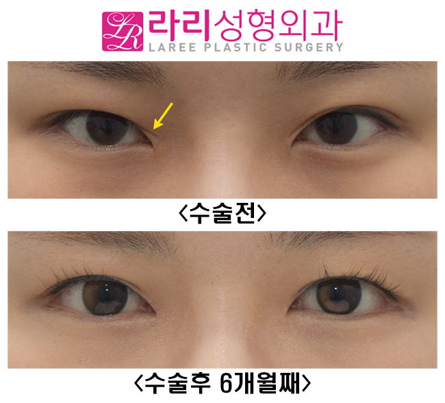 [라리성형외과]  앞트임복원수술 하지 않고 앞트임흉터 제거하는 방법 관련 이미지 2