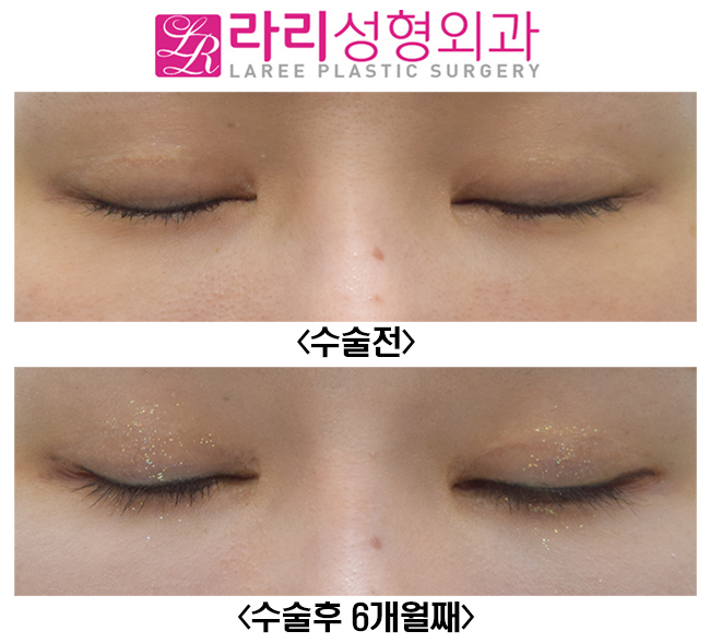 [Rari Plastic Surgery] Eyelid Surgery That Suits Me / Revision Double Eyelid Surgery, Revision Epicanthoplasty, Revision Lateral Canthoplasty image 4