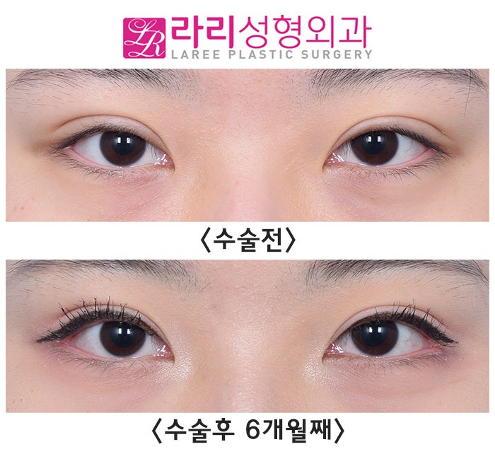 [라리성형외과] 6개월 차 자연스럽지만 티나는 눈꼬리내리기뒤트임 수술 전후 사진 관련 이미지 1