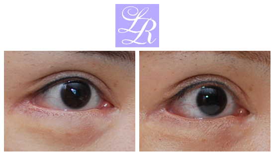 If You Want an S-Line Under Your Eyes, Try Lower Eye Widening image 4