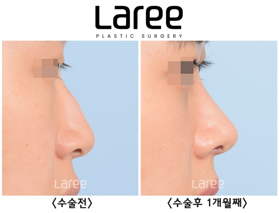 [Lari Plastic Surgery] Hump Nose Surgery Is Performed Naturally Without Implants. (No Implants, Septal Cartilage) image 1