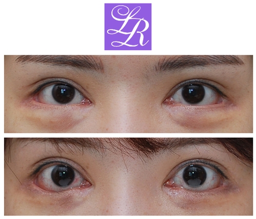 Long-Term Follow-Up Review Confirming the Effect of Lower Canthoplasty image 8