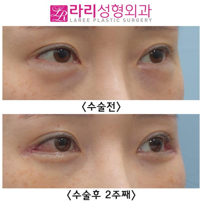 [라리성형외과] 뒤트임재수술 실밥 제거 당일 수술후 2주째 단기 경과 전후 사진 관련 이미지 1