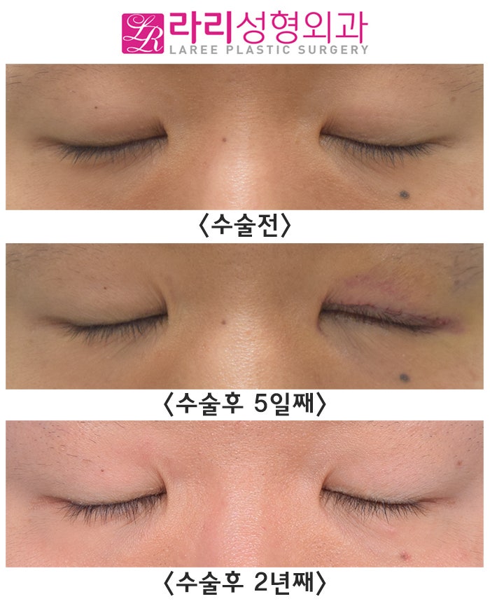 [Lari Plastic Surgery] Double Eyelid Removal: Long-Term Before-and-After Photos of Surgery on Only One Side image 2