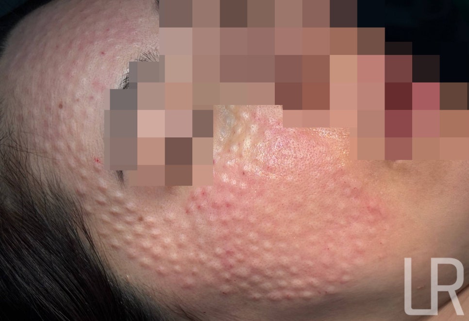 [Lari Plastic Surgery] Rejuran Treatments That Help Strengthen Your Skin’s Natural Ability to Become Healthy Begin at Lari Plastic Surgery. image 6