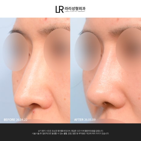 [Lari Plastic Surgery] If You Are Considering Nose Surgery, Do Not Get Nose Thread-Lifting Procedures Like Misko / Hiko!! image 12
