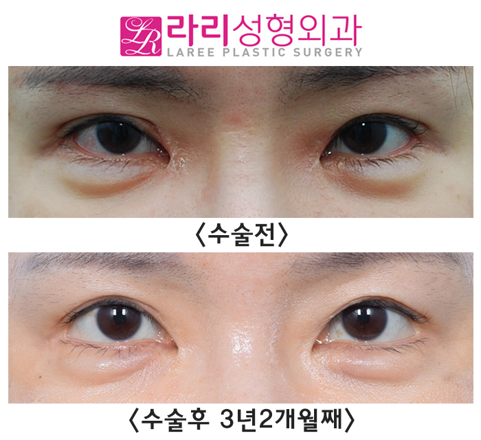 [라리성형외과] "절개쌍꺼풀재수술, 앞트임 복원 후 앞트임재수술, 눈꼬리내리기 뒤트임재수술" 효과 한 번에 보기 관련 이미지 3