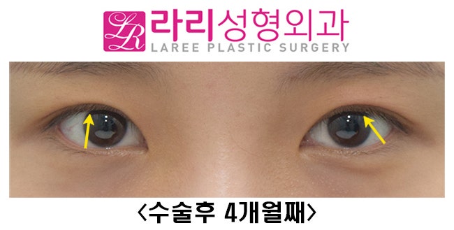 [Lari Plastic Surgery] Revision Double Eyelid Surgery to Correct Mucosal Exposure Caused by Sausage-Like Eyelids image 2