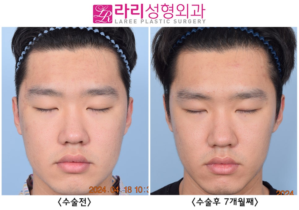 [라리성형외과] 쌍꺼풀 없애는 수술로 쌍꺼풀 없애기, 그 후 달라지는 얼굴 전체의 인상 관련 이미지 4