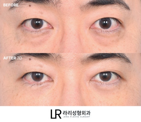[라리성형외과] 하루(1DAY) 투자로 예뻐지는 라리성형외과의 퀵 눈밑지방재배치수술 관련 이미지 6
