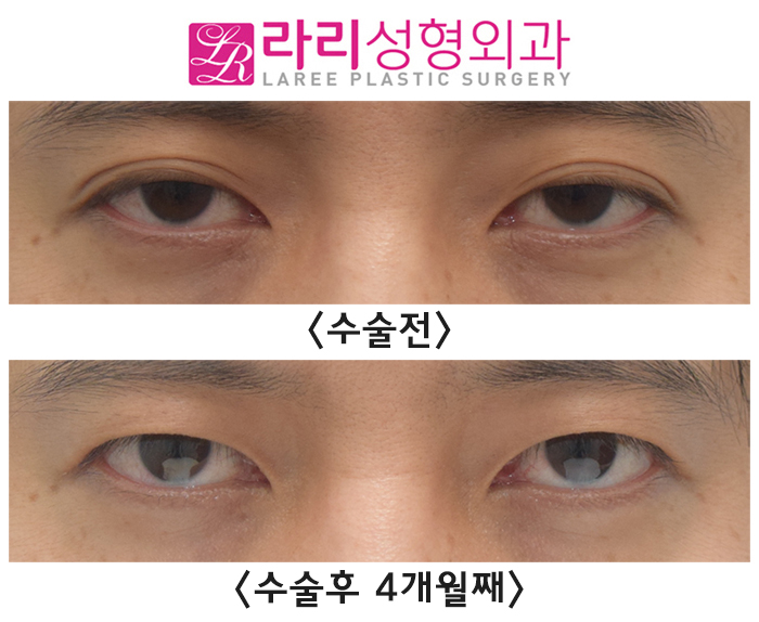 [라리성형외과] 자연쌍꺼풀 지워서 무쌍꺼풀 만드는 눈 수술 전후 사진 관련 이미지 4