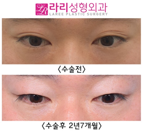 [라리성형외과] 자연쌍꺼풀없애기 2년 이상 장기 경과 전후 사진 관련 이미지 3