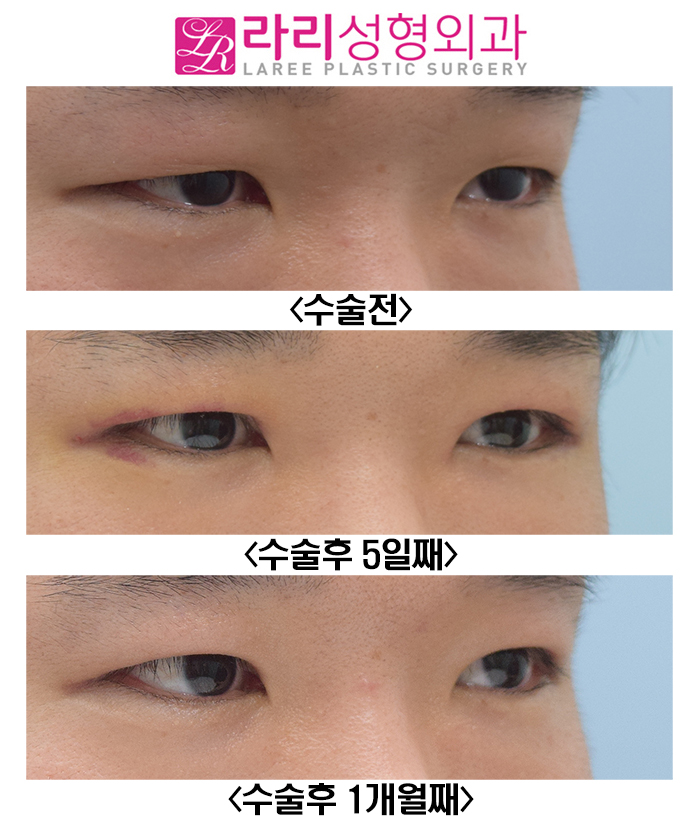 [Rari Plastic Surgery] Recovery Progress After Male Incisional Eye Opening Correction and Double-Eyelid-Free Eye Opening Correction Surgery: Natural and Neat image 4