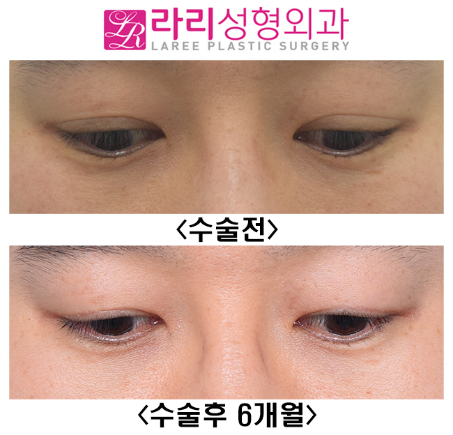 [라리성형외과] 눈을 떠도 눈을 감아도 쌍꺼풀이 없는 쌍꺼풀없애기 관련 이미지 3