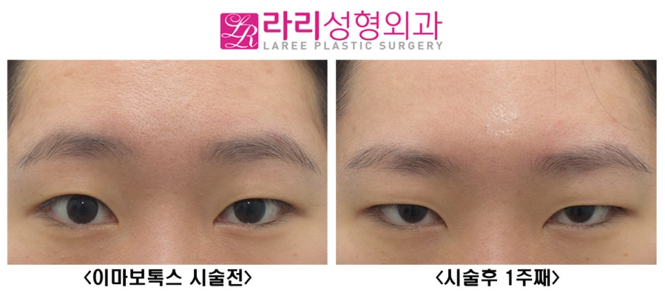 [Lari Plastic Surgery] How Forehead Botox Can Correct Asymmetrical Eyes! image 1