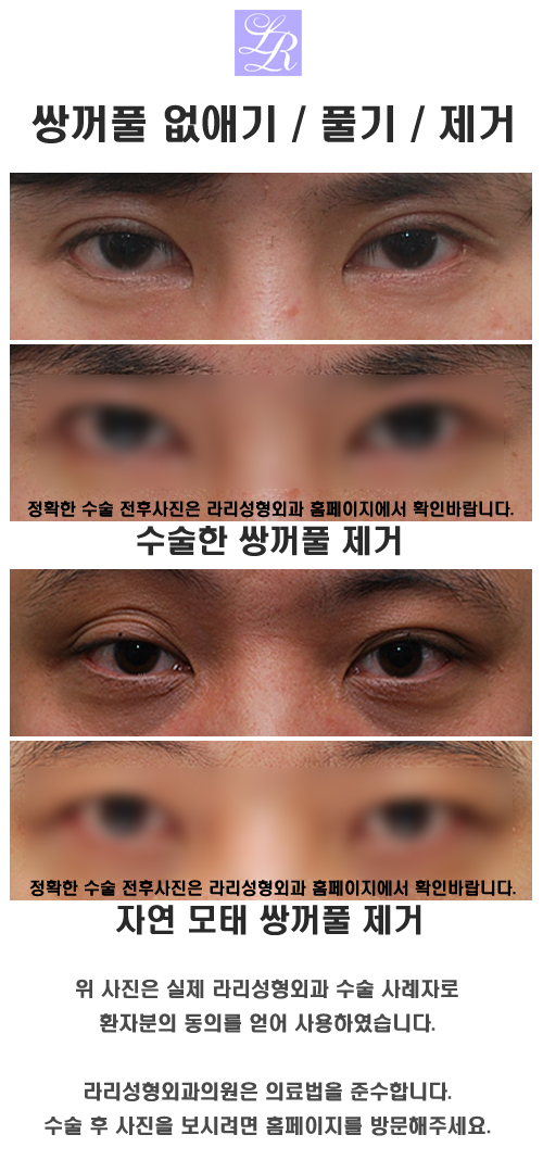 남자눈매교정, 무쌍이 대세 관련 이미지 5