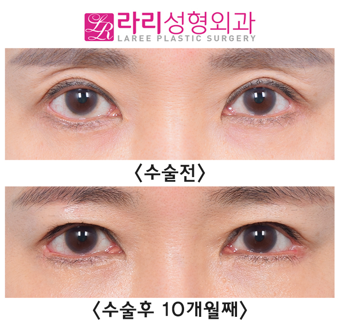 [Lari Plastic Surgery] Sunken Upper Eyelids -> Loop Fat Grafting -> Before-and-After Sunken-Eye Correction Photos image 1
